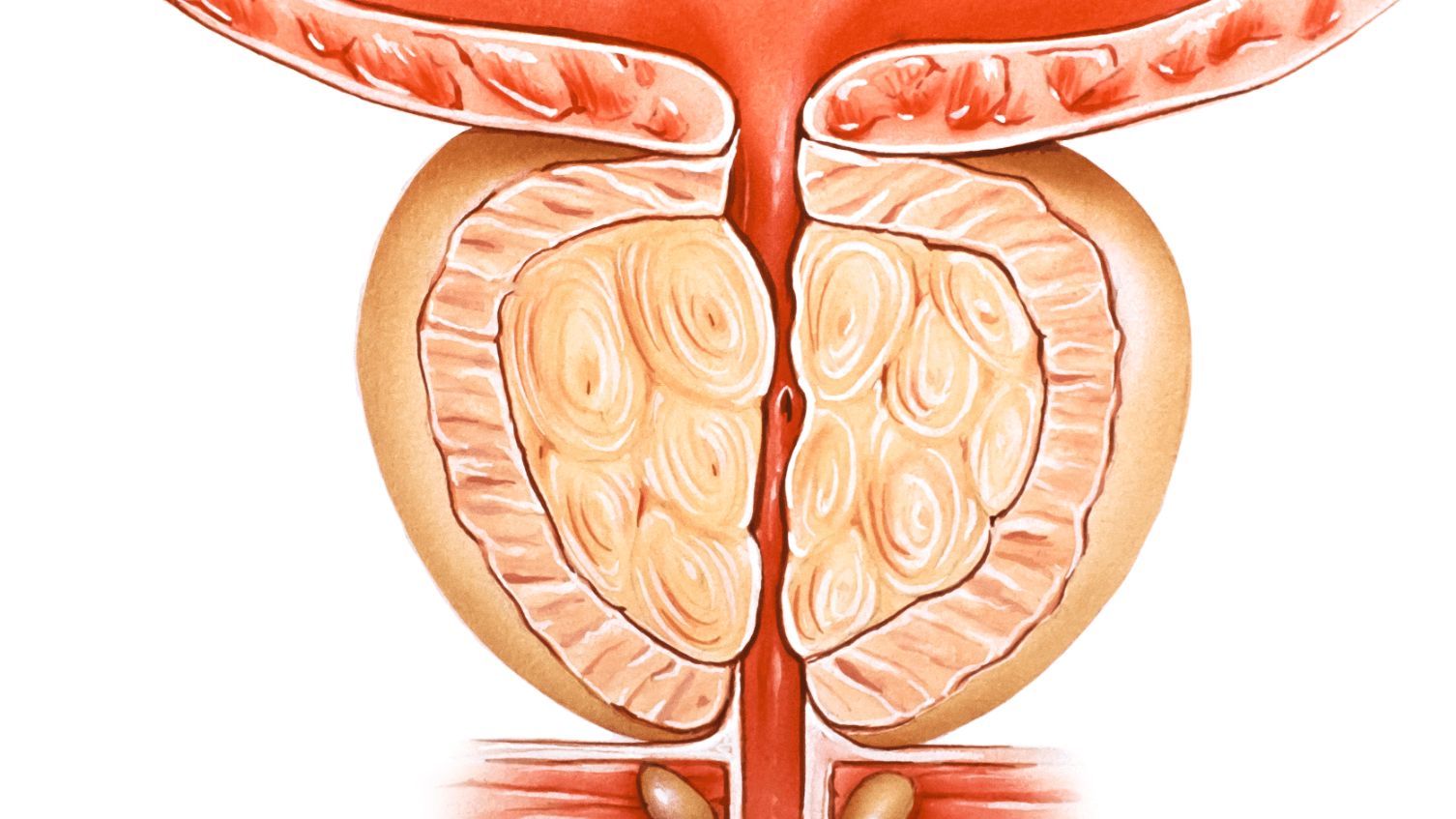 Аденома предстательной железы. Анатомия аденомы предстательной железы. Доброкачественная гиперплазия предстательной железы. Аденома предстательной железы (аденома простаты). Красивая простата